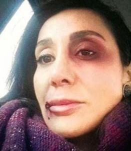 Eda Sönmez, şiddete uğramasının ardından sosyal medyada fotoğrafını paylaşmıştı. 