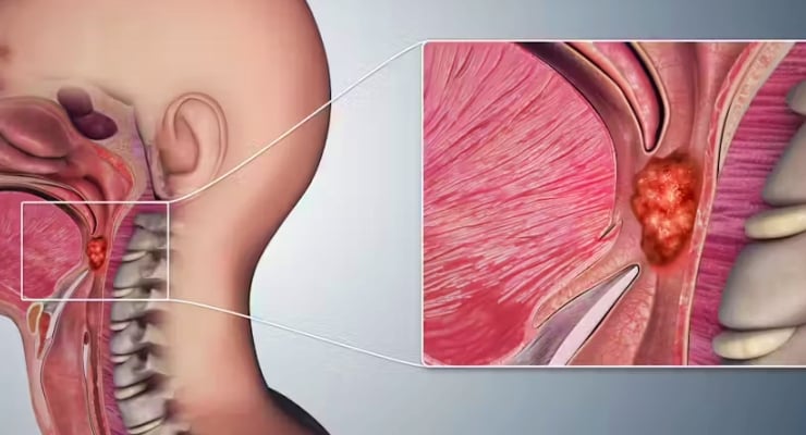 Araştırma: Oral seks gırtlak kanserinin baş nedeni