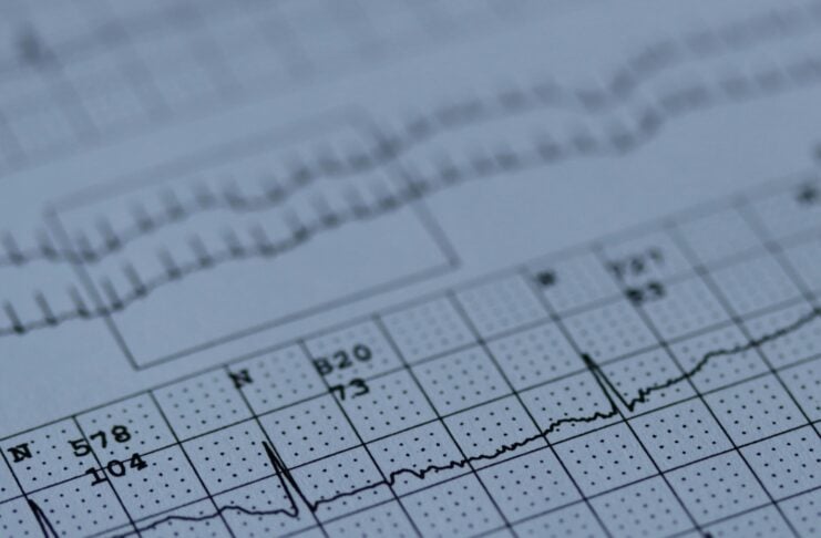 Close-up of an electrocardiogram tracing on grid paper, showing heartbeat spikes and rhythms.