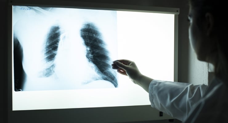 Medical professional holds a chest X-ray on a backlit viewbox, examining the lungs.